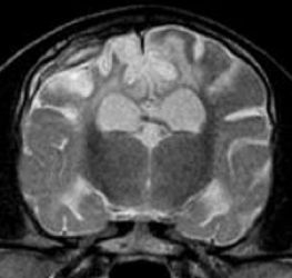 Subdural Hematoma with MRI imaging