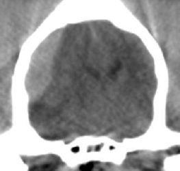 Subdural Hematoma with CT imaging